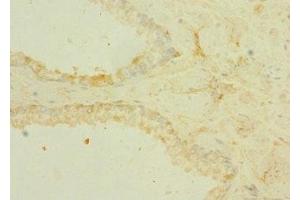 Immunohistochemistry of paraffin-embedded human prostate cancer using ABIN7172868 at dilution of 1:100 (TRPM6 抗体  (AA 740-840))