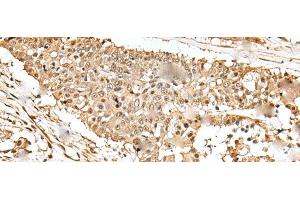 Immunohistochemistry of paraffin-embedded Human colorectal cancer tissue using EEF1E1 Polyclonal Antibody at dilution of 1:35(x200) (EEF1E1 抗体)