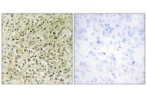 Immunohistochemistry analysis of paraffin-embedded human prostate carcinoma tissue, using RHG07 antibody. (DLC1 抗体  (N-Term))
