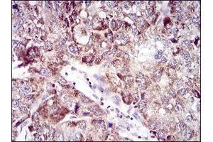 Immunohistochemical analysis of paraffin-embedded liver cancer tissues using UBE2C mouse mAb with DAB staining. (UBE2C 抗体  (AA 1-179))