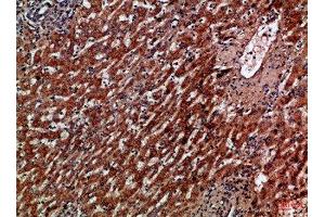 Immunohistochemical analysis of paraffin-embedded Human-liver-cancer, antibody was diluted at 1:100 (CXCR1 抗体  (AA 1-50))