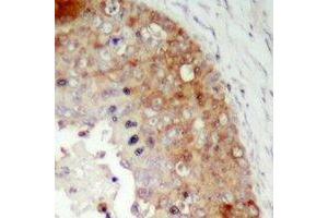 Immunohistochemical analysis of LRRC41 staining in human prostate cancer formalin fixed paraffin embedded tissue section. (LRRC41 抗体)