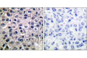 Immunohistochemistry analysis of paraffin-embedded human breast carcinoma tissue, using MMP-14 Antibody. (MMP14 抗体  (AA 471-520))