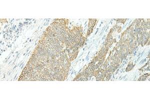 Immunohistochemistry of paraffin-embedded Human esophagus cancer tissue using ETAA1 Polyclonal Antibody at dilution of 1:25(x200) (ETAA1 抗体)