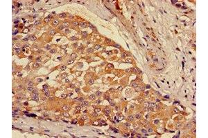 Immunohistochemistry of paraffin-embedded human breast cancer using ABIN7154002 at dilution of 1:100 (GCLM 抗体  (Regulatory Subunit))