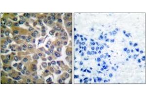 Immunohistochemistry analysis of paraffin-embedded human breast carcinoma tissue, using FAP-1 Antibody. (FAP 抗体  (AA 331-380))