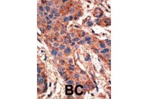 Formalin-fixed and paraffin-embedded human cancer tissue reacted with the primary antibody, which was peroxidase-conjugated to the secondary antibody, followed by AEC staining. (BMPR1A 抗体  (N-Term))