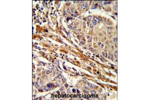 Formalin-fixed and paraffin-embedded human hepatocarcinoma reacted with APRT Antibody , which was peroxidase-conjugated to the secondary antibody, followed by DAB staining. (APRT 抗体  (C-Term))