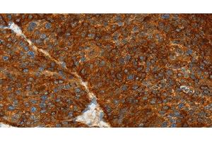 Immunohistochemistry of paraffin-embedded Human liver cancer using ASGR1 Polyclonal Antibody at dilution of 1:50 (Asialoglycoprotein Receptor 1 抗体)