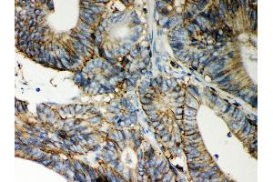 Anti- CD44 Picoband antibody, IHC(P) IHC(P): Human Intestinal Cancer Tissue (CD44 抗体  (N-Term))