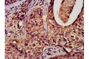 Immunohistochemistry analysis of human cervical cancer using ABIN7150829 at dilution of 1:100 (Dynamin 1-Like 抗体  (AA 496-710))