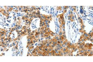 Immunohistochemistry of paraffin-embedded Human lung cancer using CKAP4 Polyclonal Antibody at dilution of 1:50 (CKAP4 抗体)