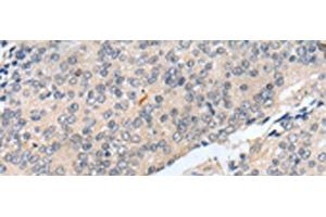 Immunohistochemistry of paraffin-embedded Human prost at e cancer tissue using MOB1B Polyclonal Antibody at dilution of 1:25(x200) (MOBKL1A 抗体)