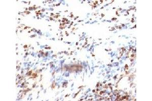 Formalin-fixed, paraffin-embedded human colon carcinoma stained with p27Kip1 antibody (KIP1/769) (CDKN1B 抗体)