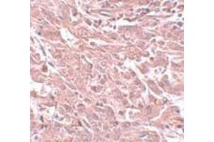 Immunohistochemistry of BCAS4 in human breast carcinoma with BCAS4 antibody at 5 μg/ml. (BCAS4 抗体  (N-Term))