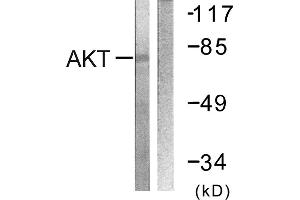 Immunohistochemistry analysis of paraffin-embedded human breast carcinoma tissue using Akt (Ab-326) antibody. (AKT1 抗体)