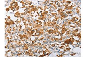 The image on the left is immunohistochemistry of paraffin-embedded Human thyroid cancer tissue using ABIN7128507(ARHGEF9 Antibody) at dilution 1/50, on the right is treated with fusion protein. (Arhgef9 抗体)