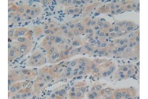 Detection of IFNa/bR1 in Human Liver cancer Tissue using Polyclonal Antibody to Interferon Alpha/Beta Receptor 1 (IFNa/bR1) (IFNAR1 抗体  (AA 28-227))