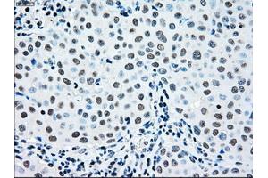 Immunohistochemical staining of paraffin-embedded Adenocarcinoma of ovary tissue using anti-MAP2K2mouse monoclonal antibody. (MEK2 抗体)
