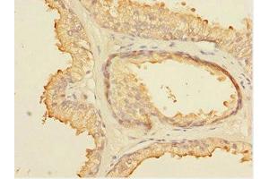 Immunohistochemistry of paraffin-embedded human prostate cancer using ABIN7152099 at dilution of 1:100 (ELF5 抗体  (AA 1-170))