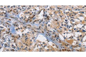 Immunohistochemistry of paraffin-embedded Human thyroid cancer using c-Fos Polyclonal Antibody at dilution of 1:70 (c-FOS 抗体)