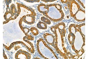 ABIN6259828 and ABIN6278001 at 1/100 staining Human ovarian cancer by IHC-P. (AGR2 抗体  (N-Term))