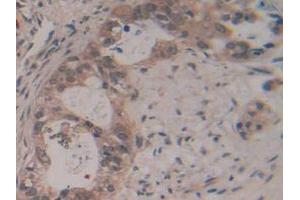 IHC-P analysis of Human Pancreas Cancer Tissue, with DAB staining. (GAP43 抗体  (AA 1-274))