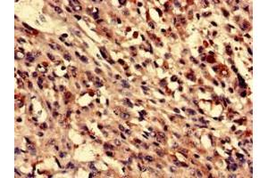 Immunohistochemistry analysis of human melanoma using ABIN7165610 at dilution of 1:100