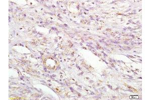 Formalin-fixed and paraffin embedded human cervical carcinoma labeled with Anti MIIP Polyclonal Antibody, Unconjugated  at 1:200 followed by conjugation to the secondary antibody and DAB staining (MIIP 抗体  (AA 251-350))