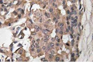 Immunohistochemistry (IHC) analyzes of Raf-B antibody in paraffin-embedded human breast carcinoma tissue. (BRAF 抗体)