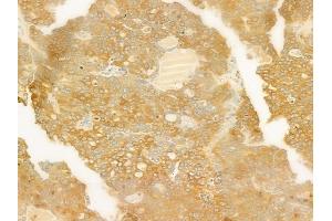 ABIN6261484 and ABIN6279421 at 1/100 staining human ovarian carcinoma by IHC-P.
