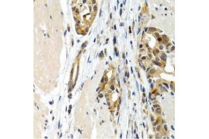 Immunohistochemistry of paraffin-embedded human stomach cancer using IL9 antibody. (IL-9 抗体)