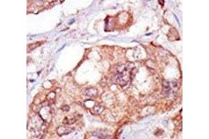 IHC analysis of FFPE human breast carcinoma tissue stained with the TNK1 antibody (TNK1 抗体  (AA 256-286))