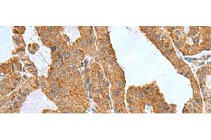 Immunohistochemistry of paraffin-embedded Human thyroid cancer tissue using ITGB1BP1 Polyclonal Antibody at dilution of 1:50(x200) (ITGB1BP1 抗体)