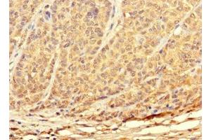 Immunohistochemistry of paraffin-embedded human ovarian cancer using ABIN7172897 at dilution of 1:100 (TKTL2 抗体  (AA 1-300))