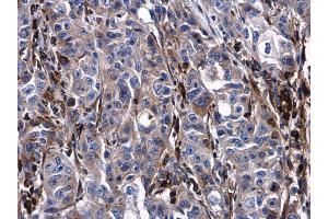 IHC-P Image Urokinase antibody detects Urokinase protein at cytoplasm and extracellular space in human esophageal carcinoma by immunohistochemical analysis. (PLAU 抗体)