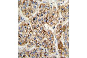 Formalin-fixed and paraffin-embedded human hepatocarcinoma with MCCC2 Antibody (Center), which was peroxidase-conjugated to the secondary antibody, followed by DAB staining. (MCCC2 抗体  (AA 163-189))