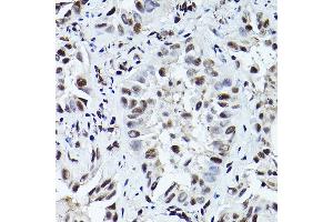 Immunohistochemistry of paraffin-embedded human lung cancer using Phospho-ATR-T1989 Rabbit pAb (ABIN7265777) at dilution of 1:200 (40x lens). (ATR 抗体  (pThr1989))