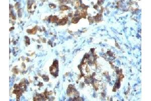 IHC testing of FFPE human gastric carcinoma with Cdc20 antibody (clone CLDC20-1) (CDC20 抗体)