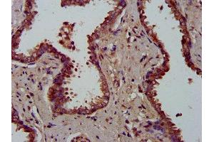 IHC image of ABIN7159706 diluted at 1:300 and staining in paraffin-embedded human prostate cancer performed on a Leica BondTM system. (MFAP4 抗体  (AA 100-191))