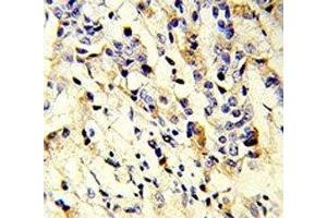 IHC analysis of FFPE human breast carcinoma stained with IGHM antibody (IGHM 抗体  (AA 103-131))