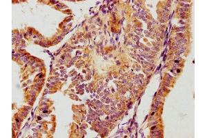 IHC image of ABIN7163242 diluted at 1:100 and staining in paraffin-embedded human endometrial cancer performed on a Leica BondTM system. (GPLD1 抗体  (AA 310-565))