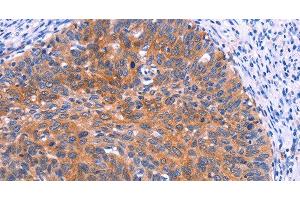 Immunohistochemistry of paraffin-embedded Human cervical cancer tissue using PTPN13 Polyclonal Antibody at dilution 1:30 (PTPN13 抗体)