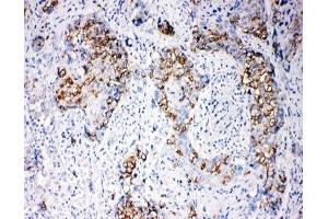 IHC-P: beta Arrestin 1 antibody testing of human breast cancer tissue (beta Arrestin 1 抗体  (N-Term))
