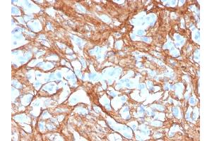 Formalin-fixed, paraffin-embedded human colon carcinoma stained with Periostin (POSTN) Mouse Monoclonal Antibody (POSTN/3501).
