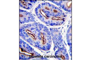 FOLH1 Antibody (N-term) (ABIN657630 and ABIN2846626) immunohistochemistry analysis in formalin fixed and paraffin embedded human prostate carcinoma followed by peroxidase conjugation of the secondary antibody and DAB staining. (PSMA 抗体  (N-Term))