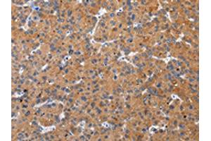 The image on the left is immunohistochemistry of paraffin-embedded Human liver cancer tissue using ABIN7193094(ZFAND2A Antibody) at dilution 1/30, on the right is treated with synthetic peptide. (ZFAND2A 抗体)