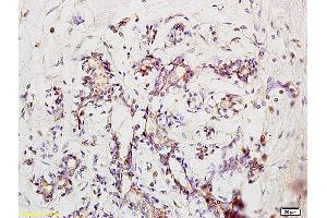 Formalin-fixed and paraffin embedded human pneumonia tissue labeled with Anti-Phospho-IRAK1 (Ser376) Polyclonal Antibody, Unconjugated at 1:200 followed by conjugation to the secondary antibody and DAB staining (IRAK1 抗体  (pSer376))
