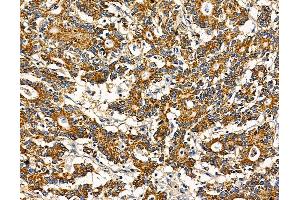 ABIN7095770 and ABIN7099832 at 1/100 staining human colorectal cancer by IHC-P. (RNF128 抗体)