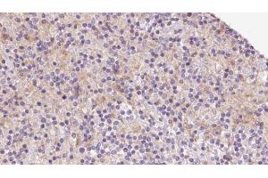 ABIN6273080 at 1/100 staining Human lymph cancer tissue by IHC-P. (TIMM22 抗体  (Internal Region))